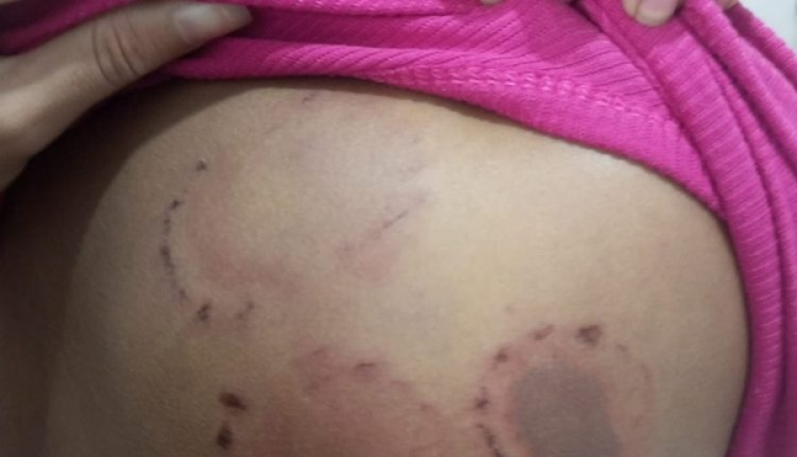 Brutalidade em Pinheiro: homem é preso suspeito de espancar companheira com socos e mordidas